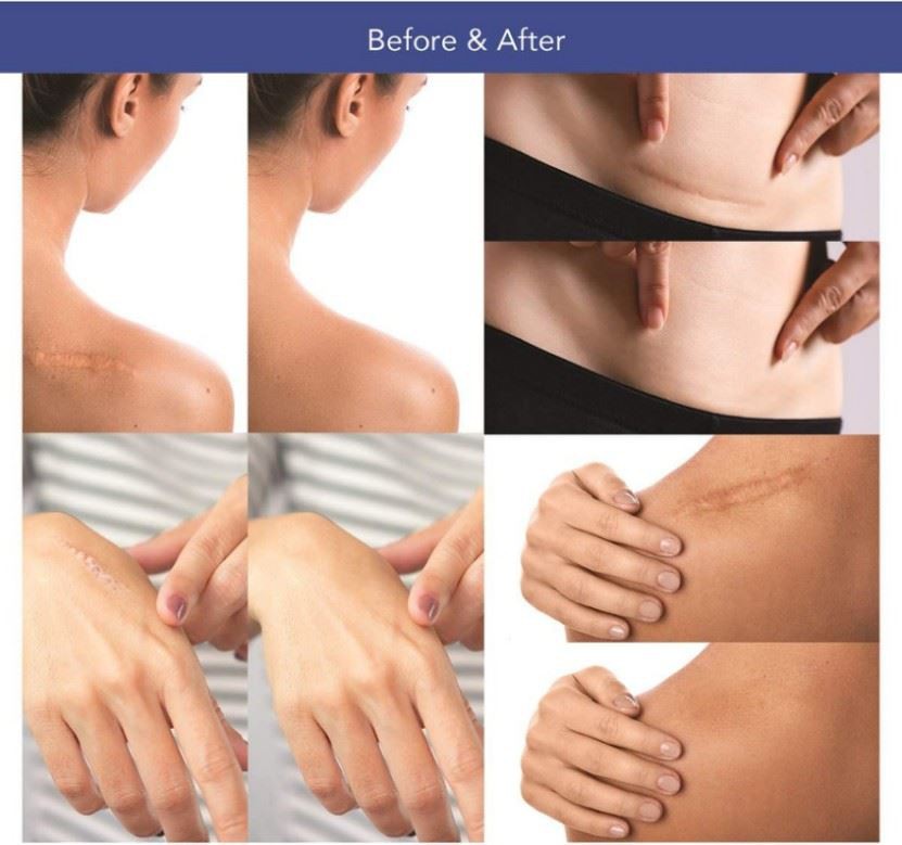 silicone gel sheets silicone gel sheets